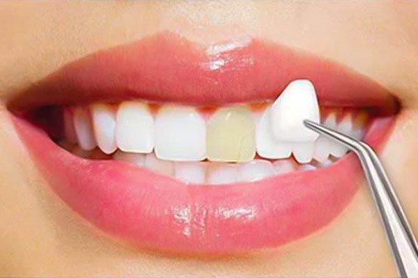 reasons to get dental veneers